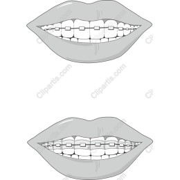 Lips with Braces
