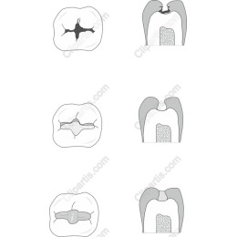 Dental Decay Set