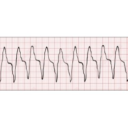 ECG Heartbeat