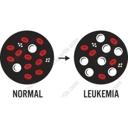 Leukemia vs Normal Blood Cells